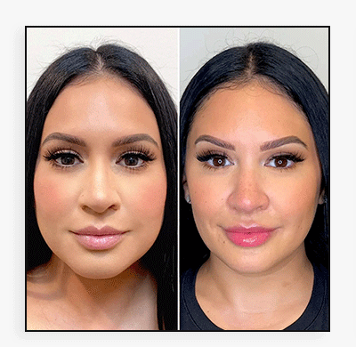 JawlineFix: Masseter Botox