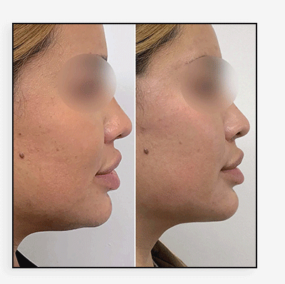 ChinFix: CoolSculpting