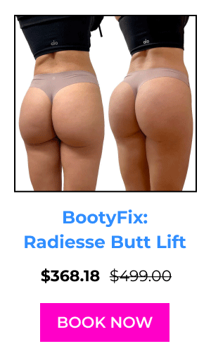 BootyFix: Radiesse Butt Lift