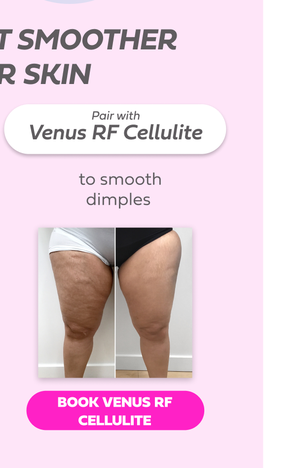 VENUS RF CELLULITE