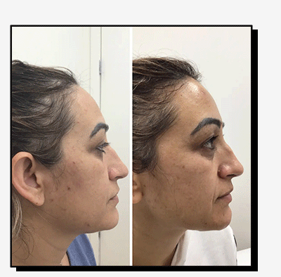 SkinFix: Laser Genesis