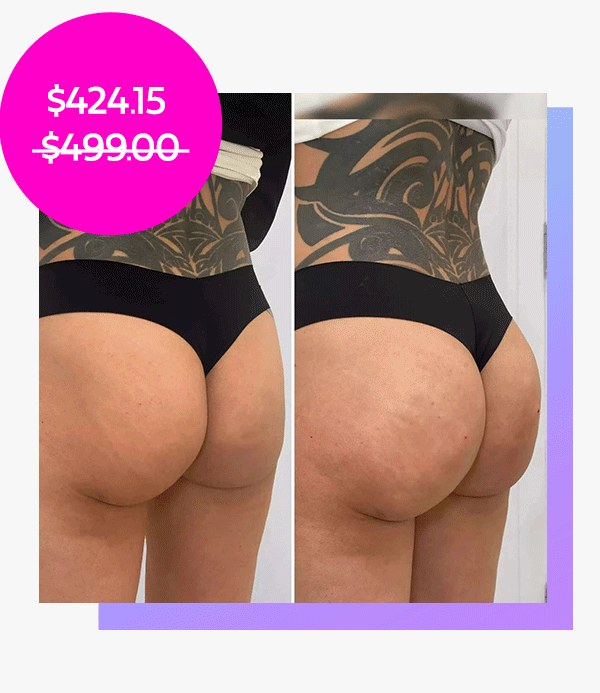BootyFix: Sculptra Butt Lift