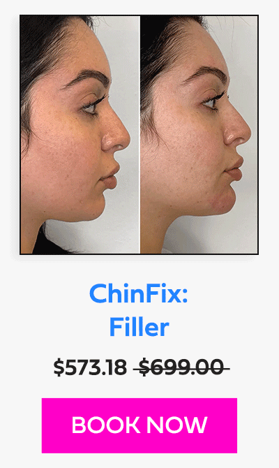 ChinFix: Filler