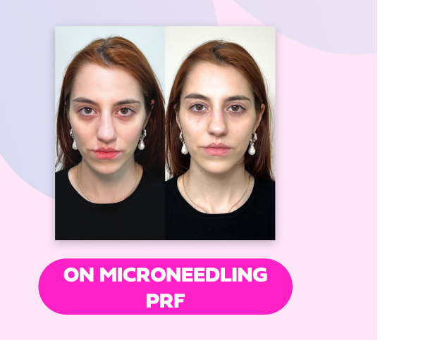 MICRONEEDLING PRF