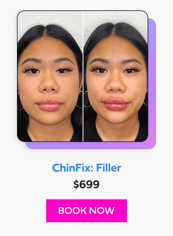 ChinFix: Filler