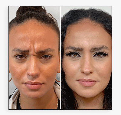 WrinkleFix: Botox (Existing Customers)