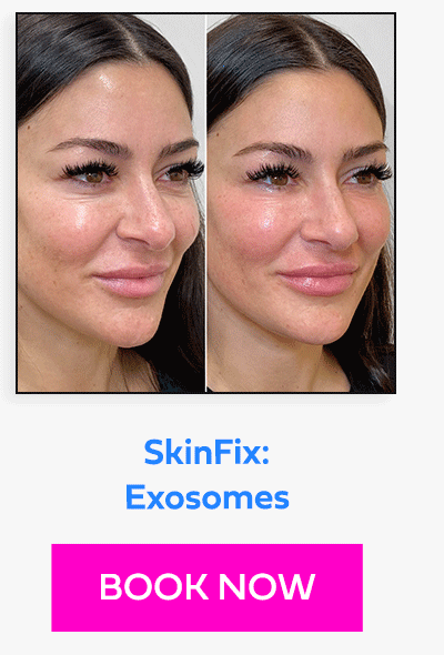 SkinFix: Exosomes