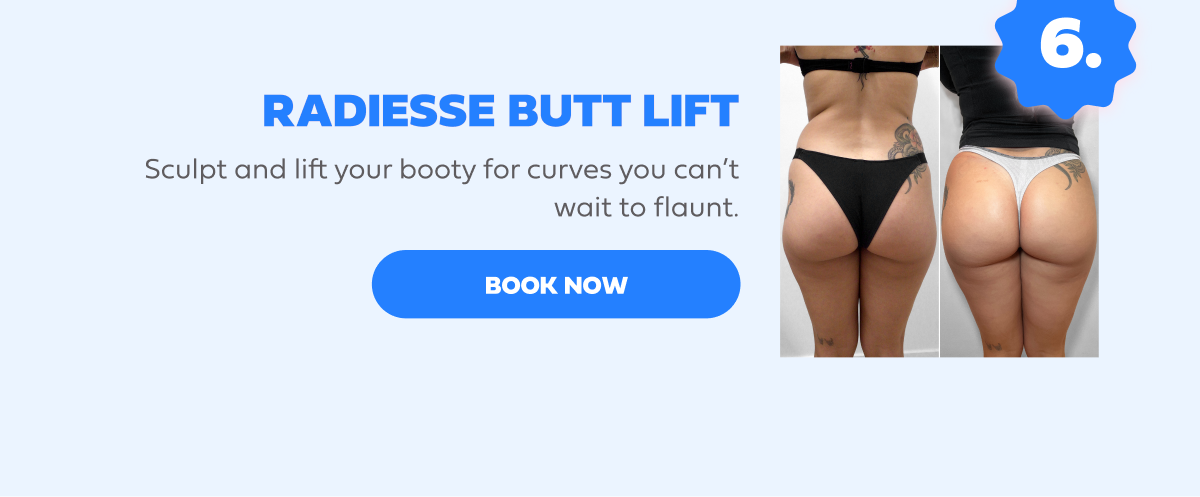 RADIESSE BUTT LIFT