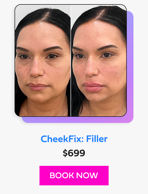CheekFix: Filler
