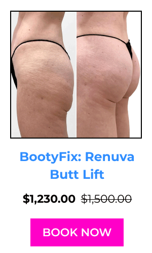 BootyFix: Renuva Butt Lift