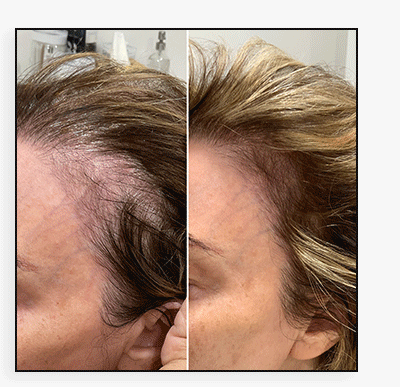HairFix: Laser Removal & Exosomes