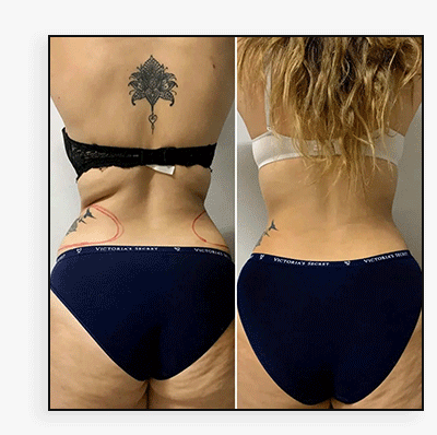 AbFix: CoolSculpting