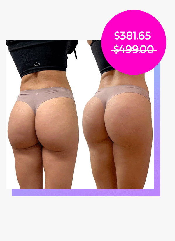 BootyFix: Radiesse Butt Lift