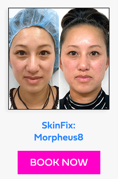 SkinFix: Morpheus8