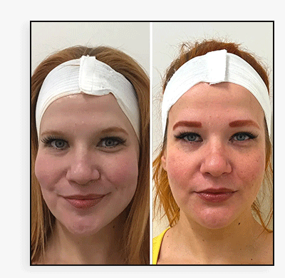 SkinFix: Microneedling