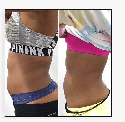 BodyFix: EmSculpt Neo