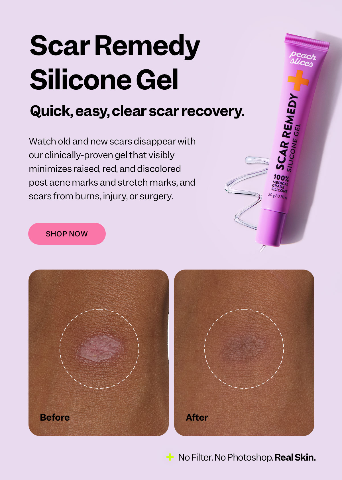 Scar Remedy Silicone Gel