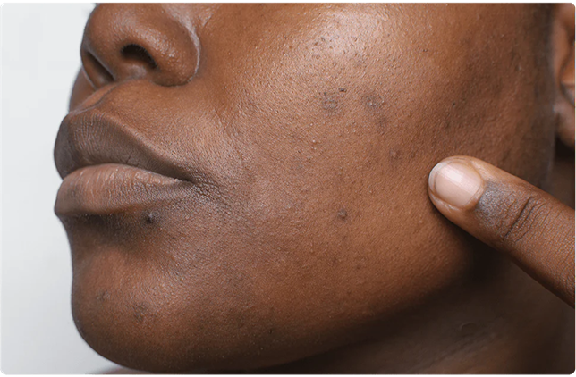 Hyperpigmentation