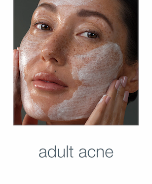 adult acne