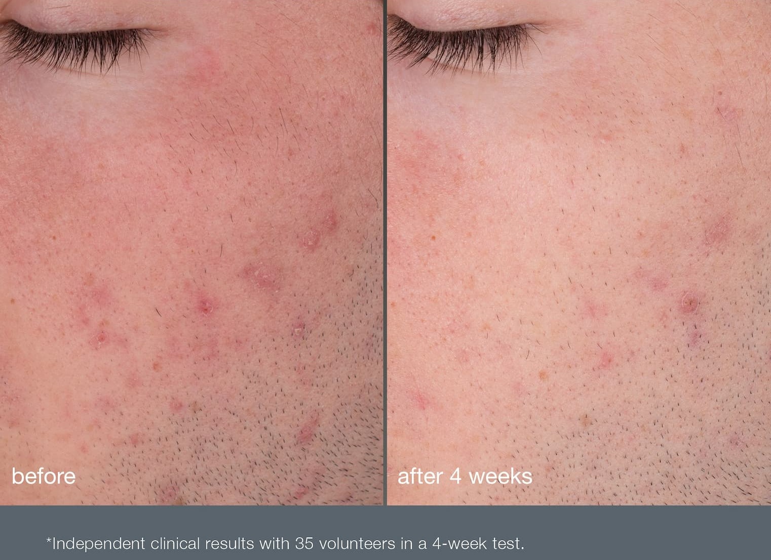 after 1-7 days of use Brightens skin and minimizes the look of dark spots | SHOP #1 EXFOLIANT