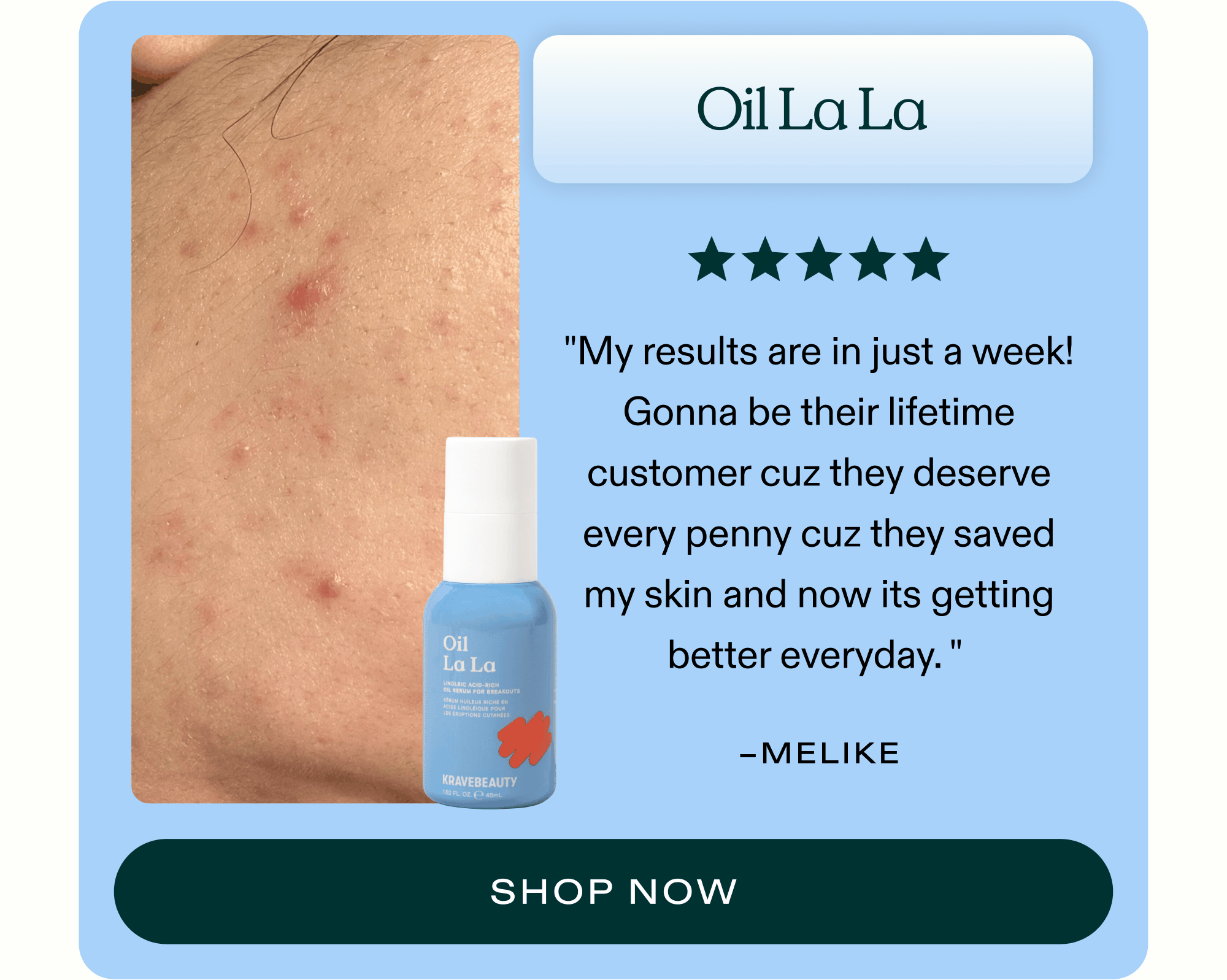Oil La La ⭐⭐⭐⭐⭐ "My ride or die product! This oil has changed my skin. It's so lightweight and keeps my pores clean and skin acne free!" - Maddie  |  SHOP NOW