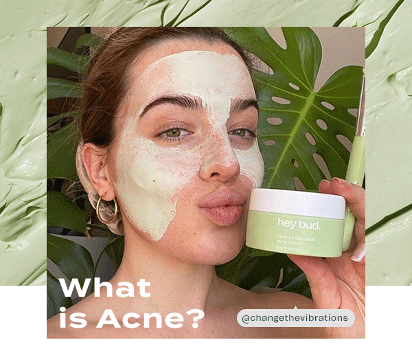 What is Acne? The Party Crasher 🎉 Hey Bud Skincare
