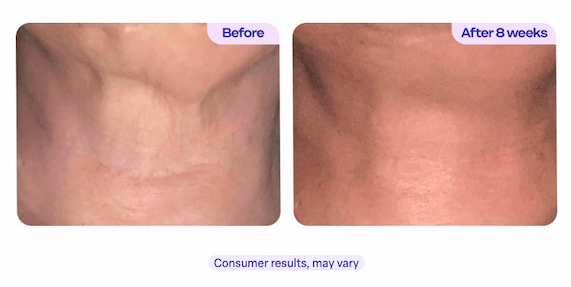 Before & after 8 weeks. Consumer results, may vary