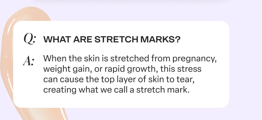 Stretch marks appear when the skin is stretched and the top layer of skin tears.