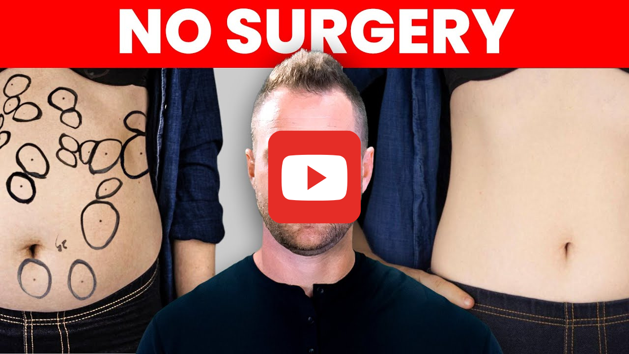 Lipoma Treatment WITHOUT Surgery…[natural remedies]