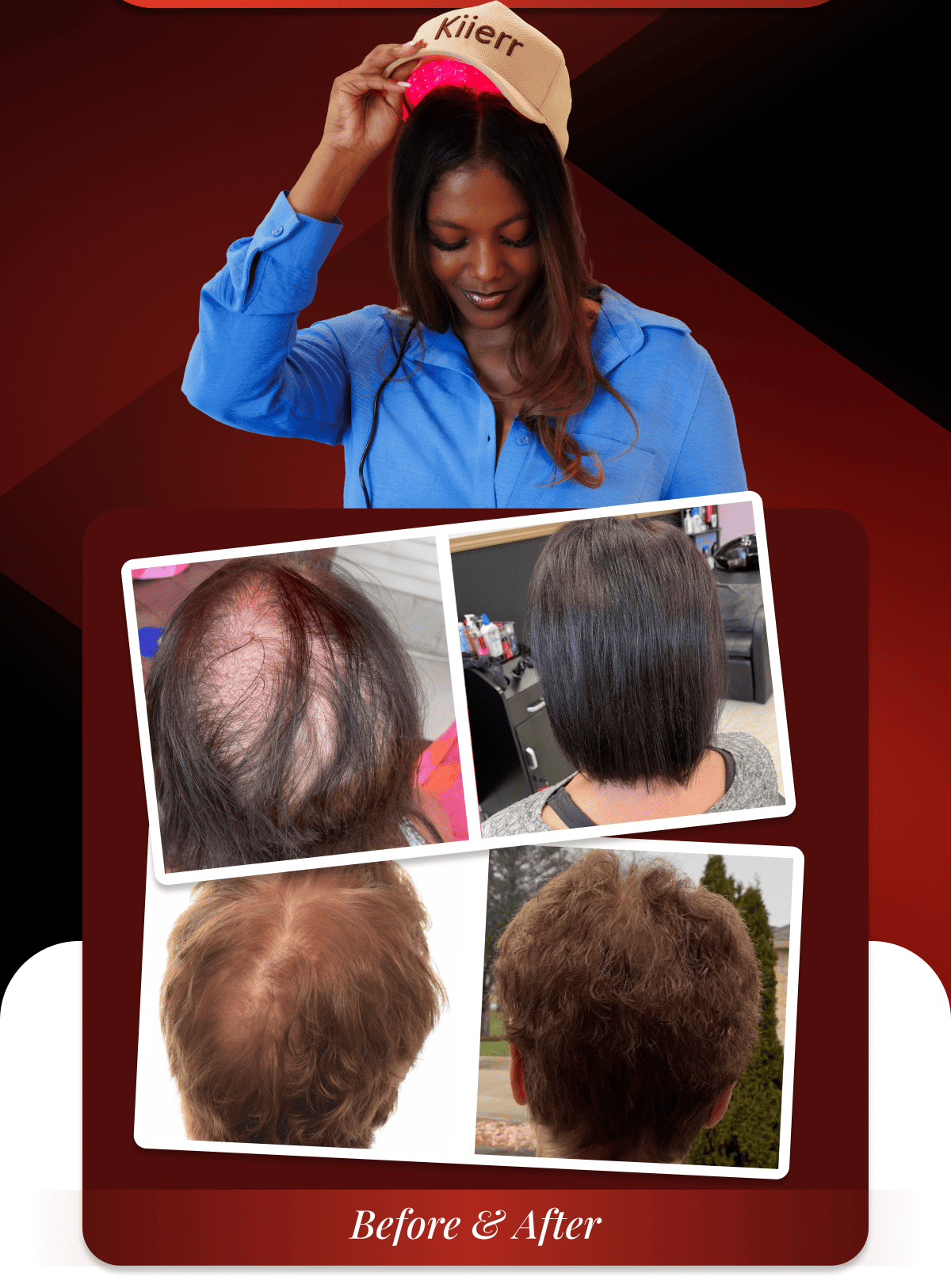 Red Light Therapy: Wake Up Dormant Follicles 312 DualWave MD Cap