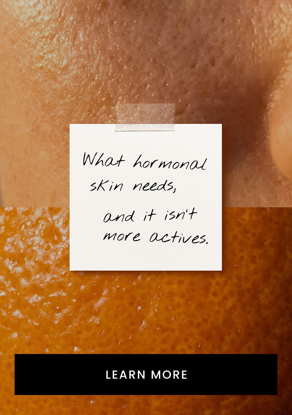 Hormonal Skin