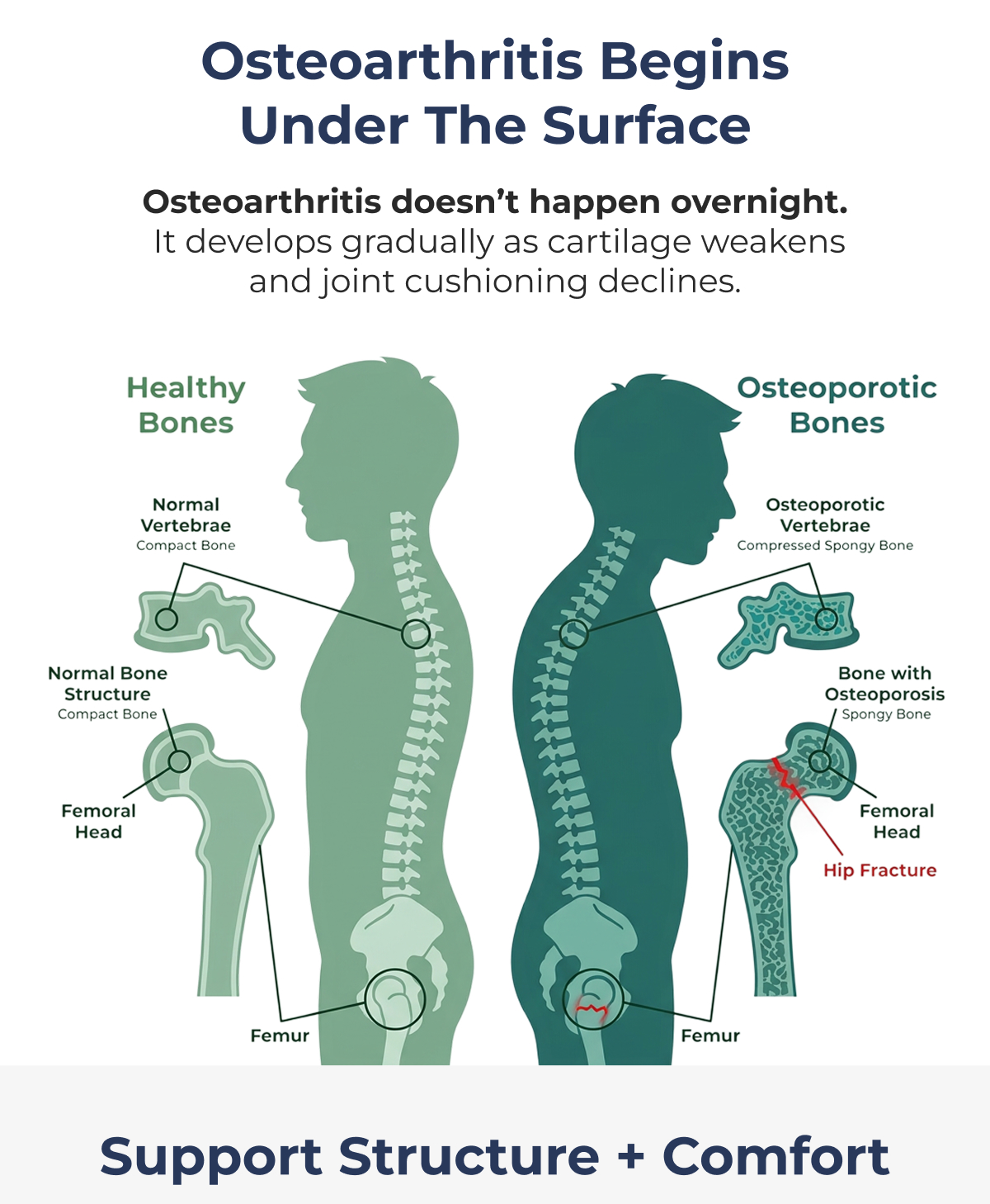 Osteoarthritis Begins Under the Surface Osteoarthritis doesn't happen overnight.  It develops gradually as cartilage weakens and joint cushioning declines.