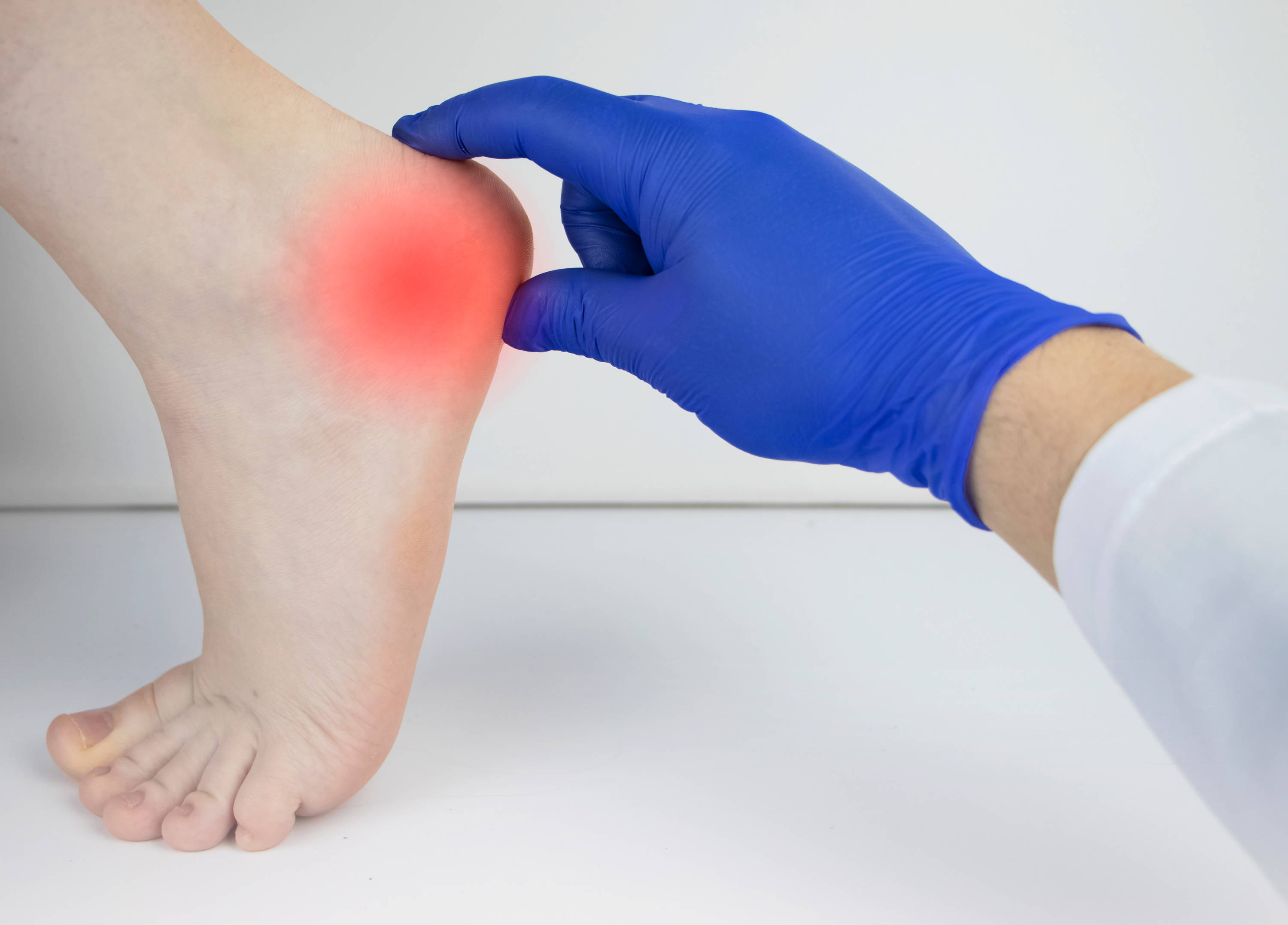 What Is Calcaneal Bursitis The Healing Sole