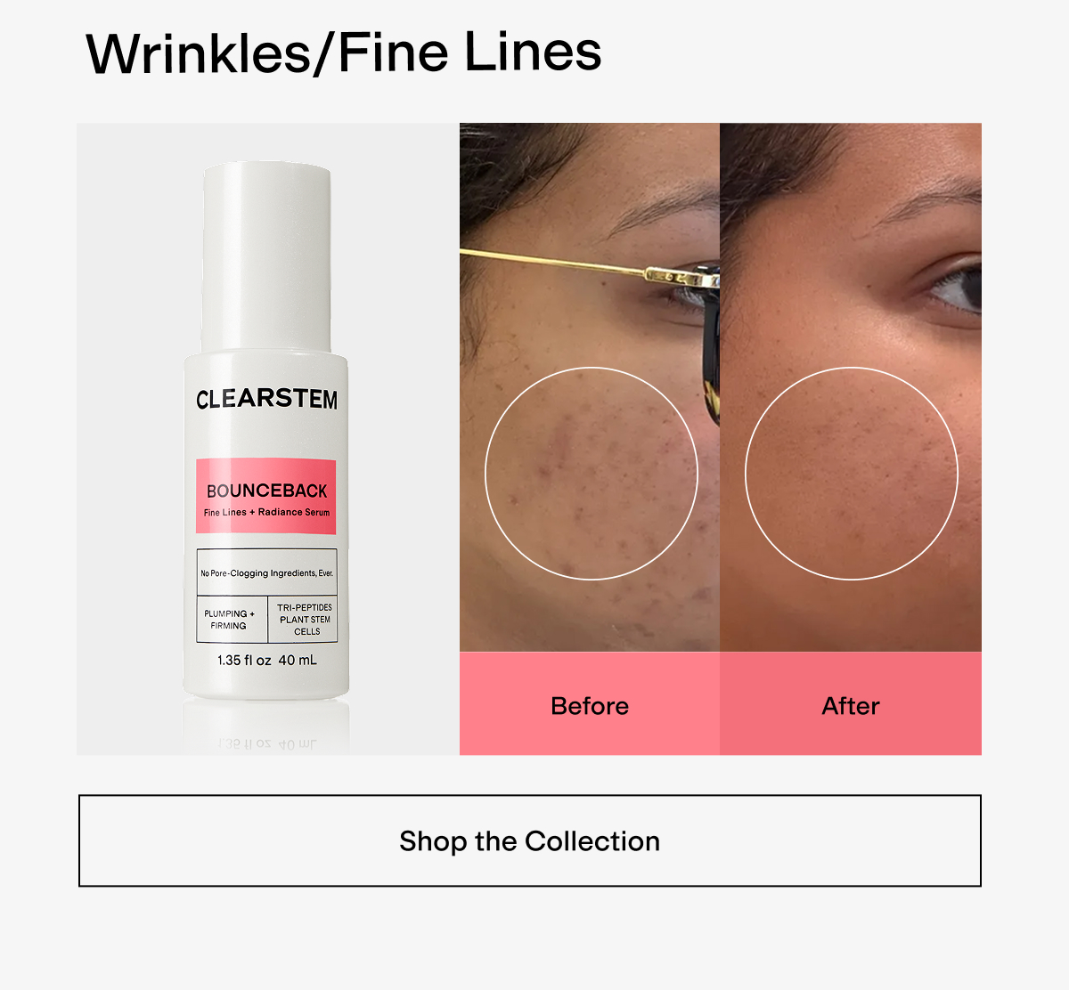 Wrinkles before & after