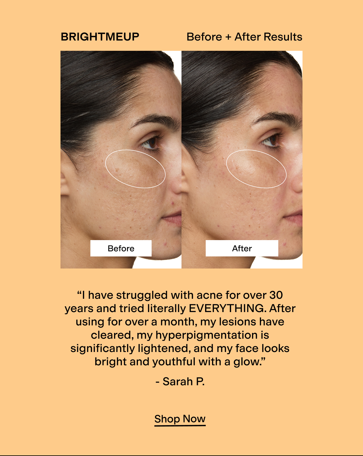 BRIGHTMEUP Before + After Results 