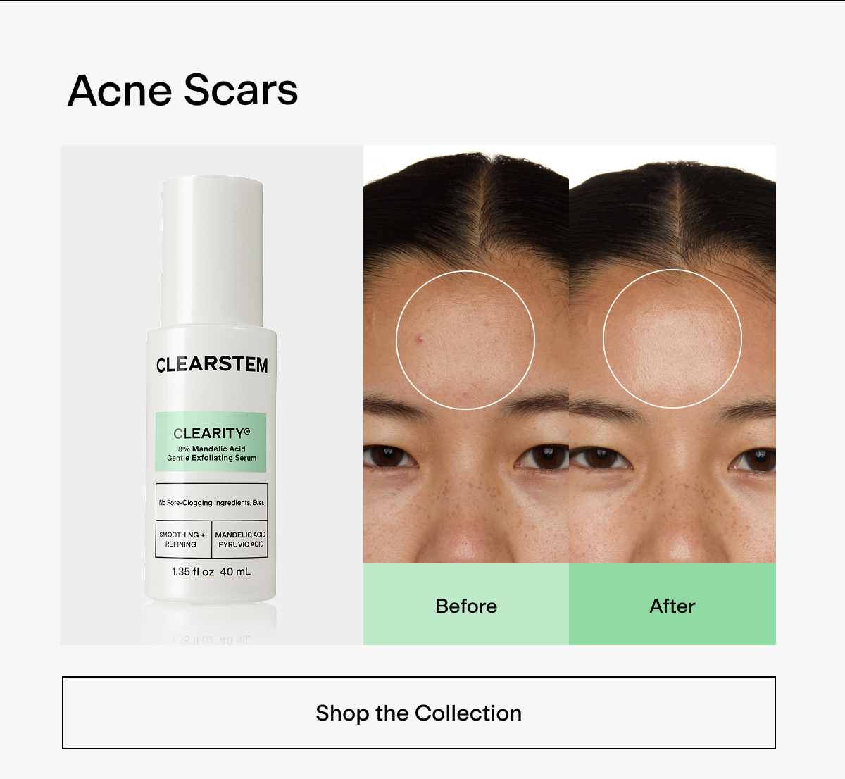 Acne Scars before & after
