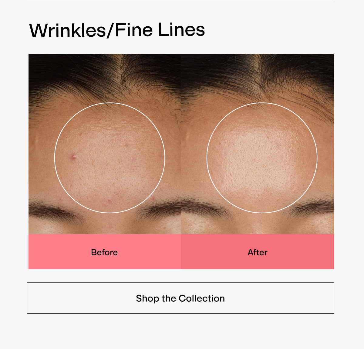 Wrinkles/Fine Lines
