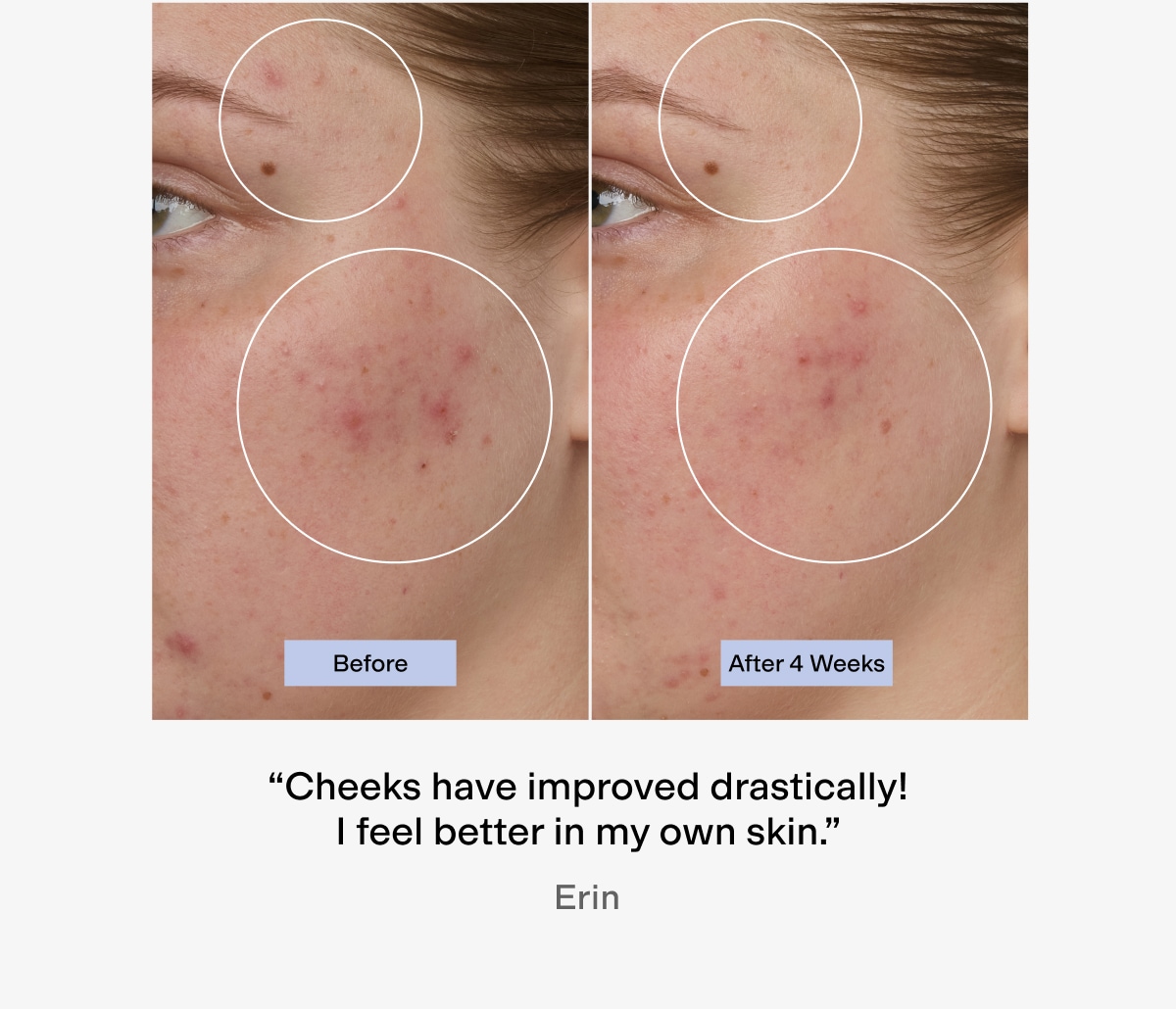 "Cheeks have improved drastically"