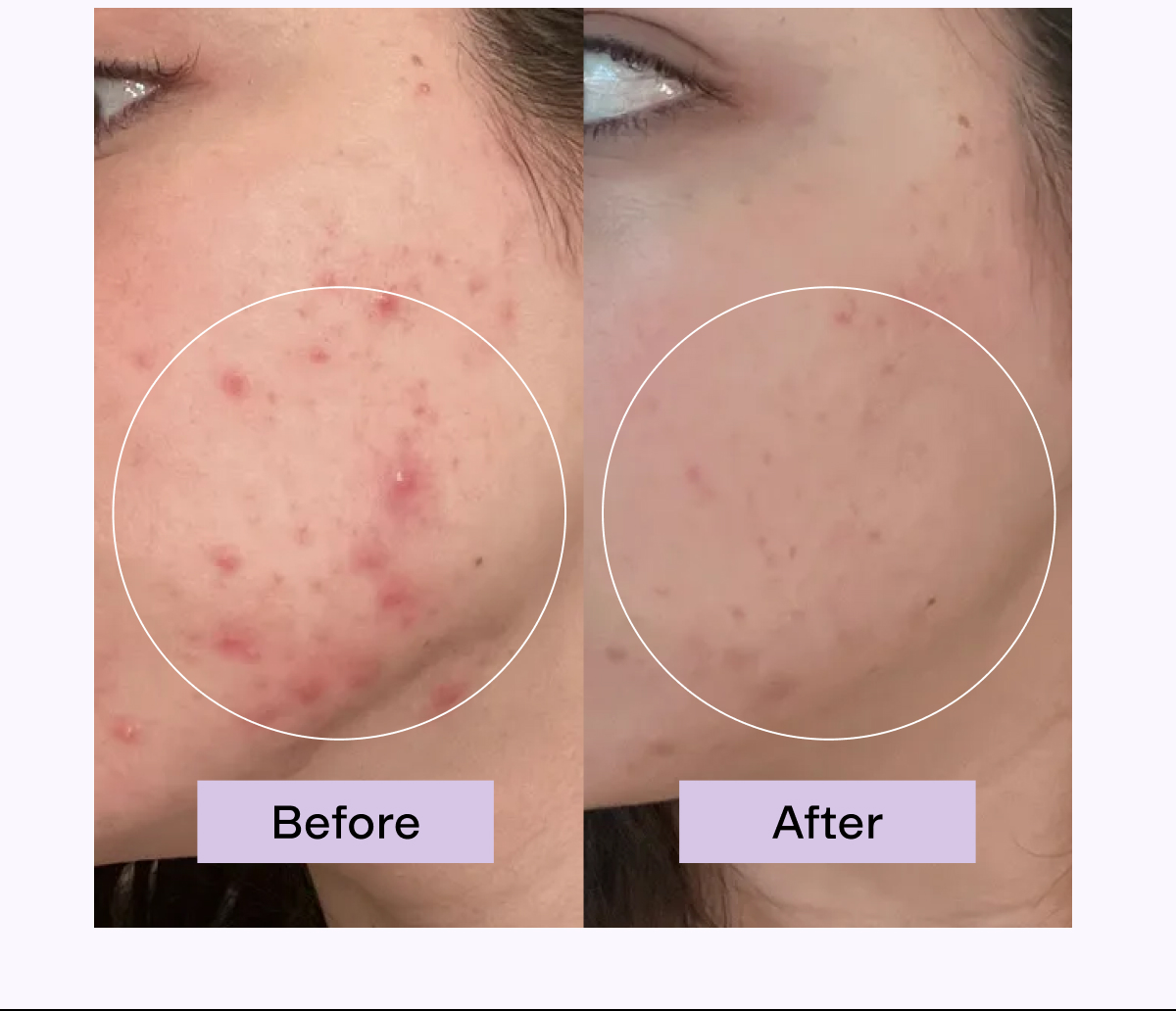 CLEARSTEM Before + After