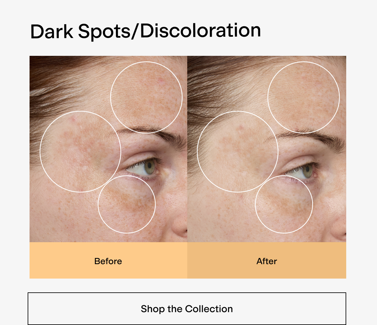 Dark Spots/Discoloration