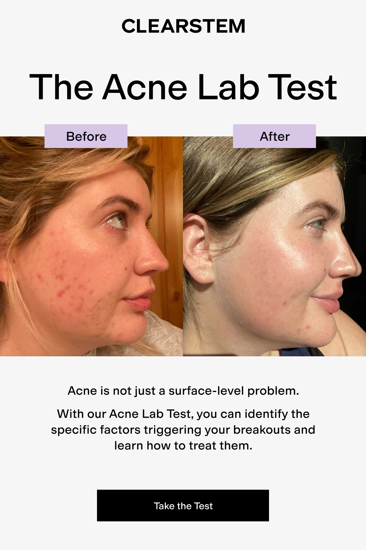 Acne Lab Test