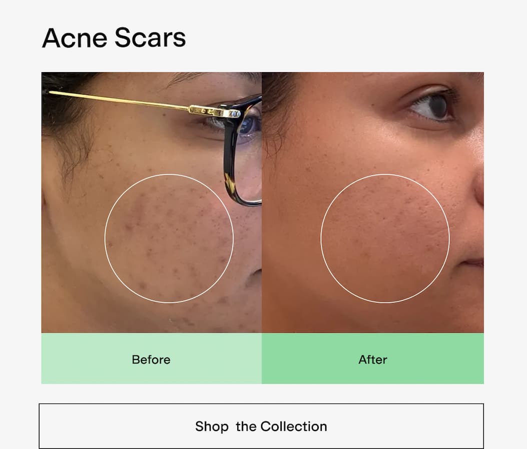 Acne Scars 