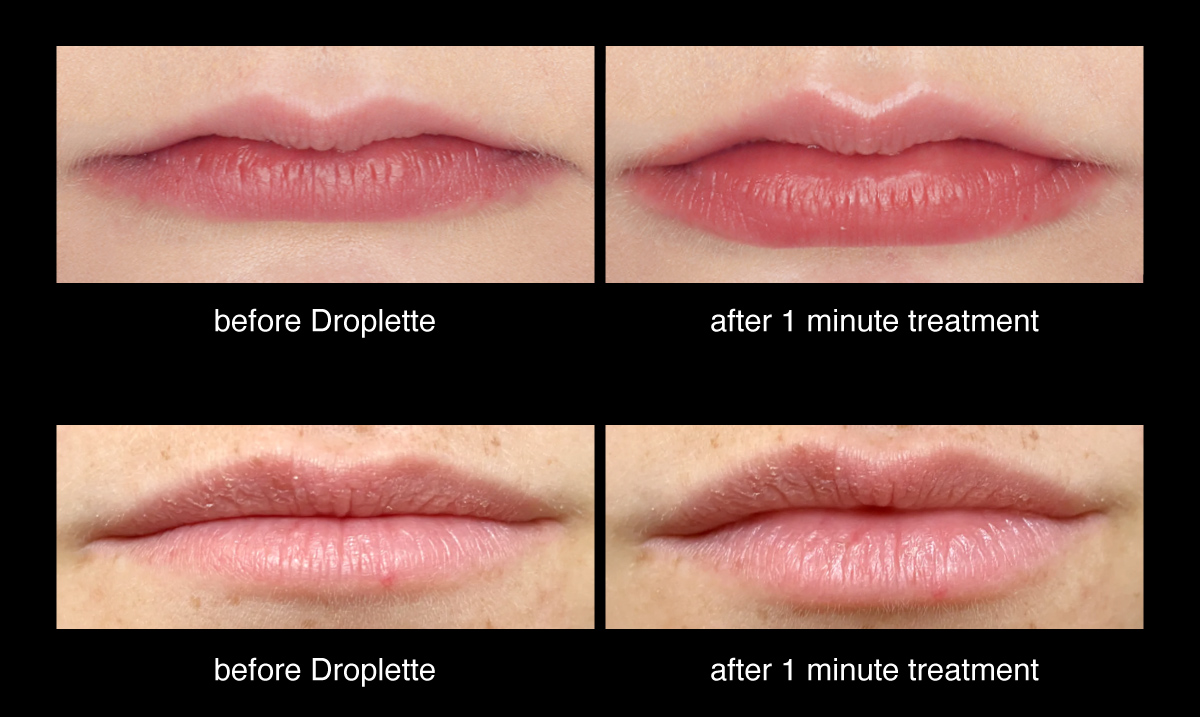 💋 Introducing NEW 17Volt Lip Plumper. Droplette