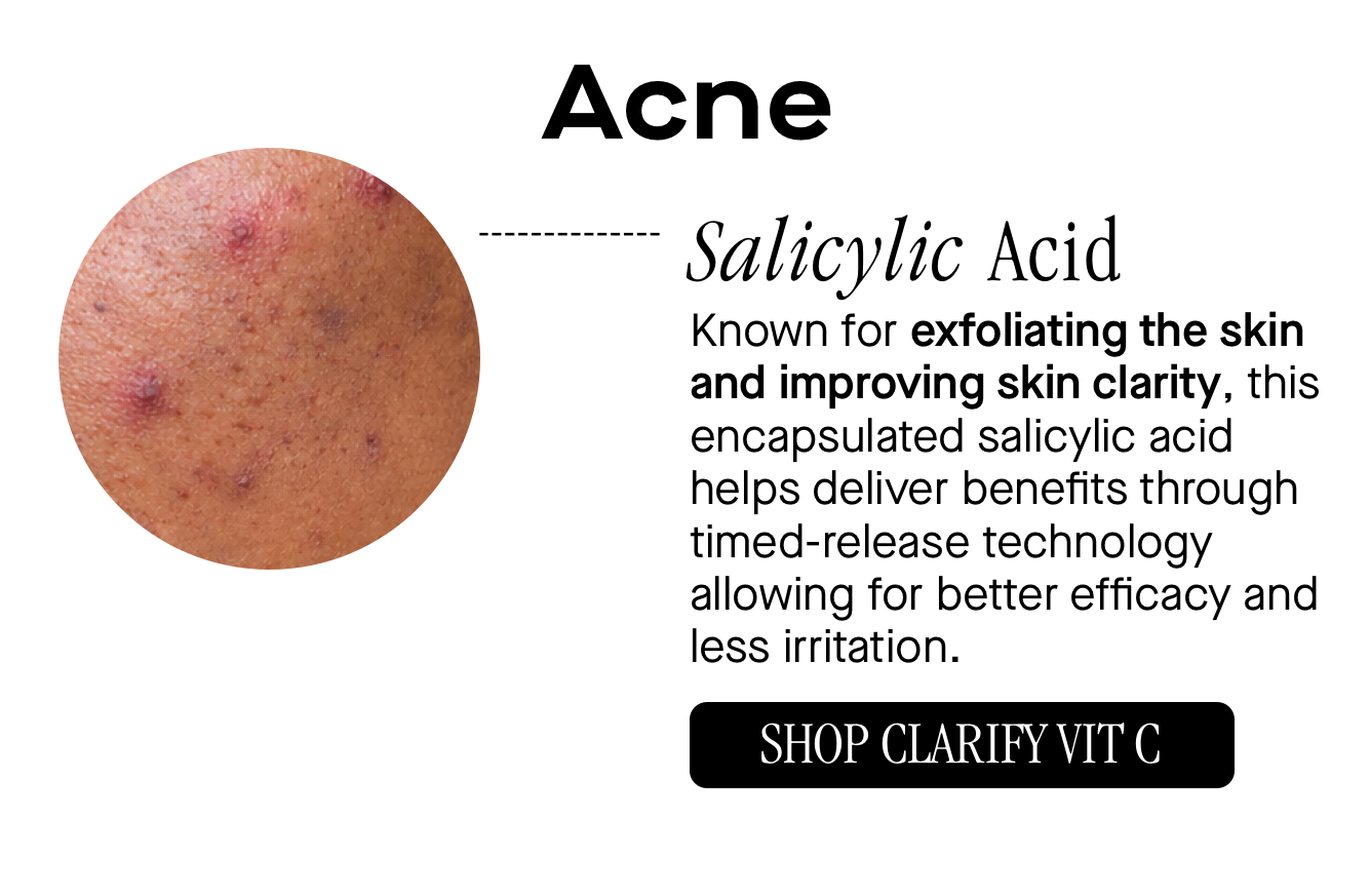 Acne