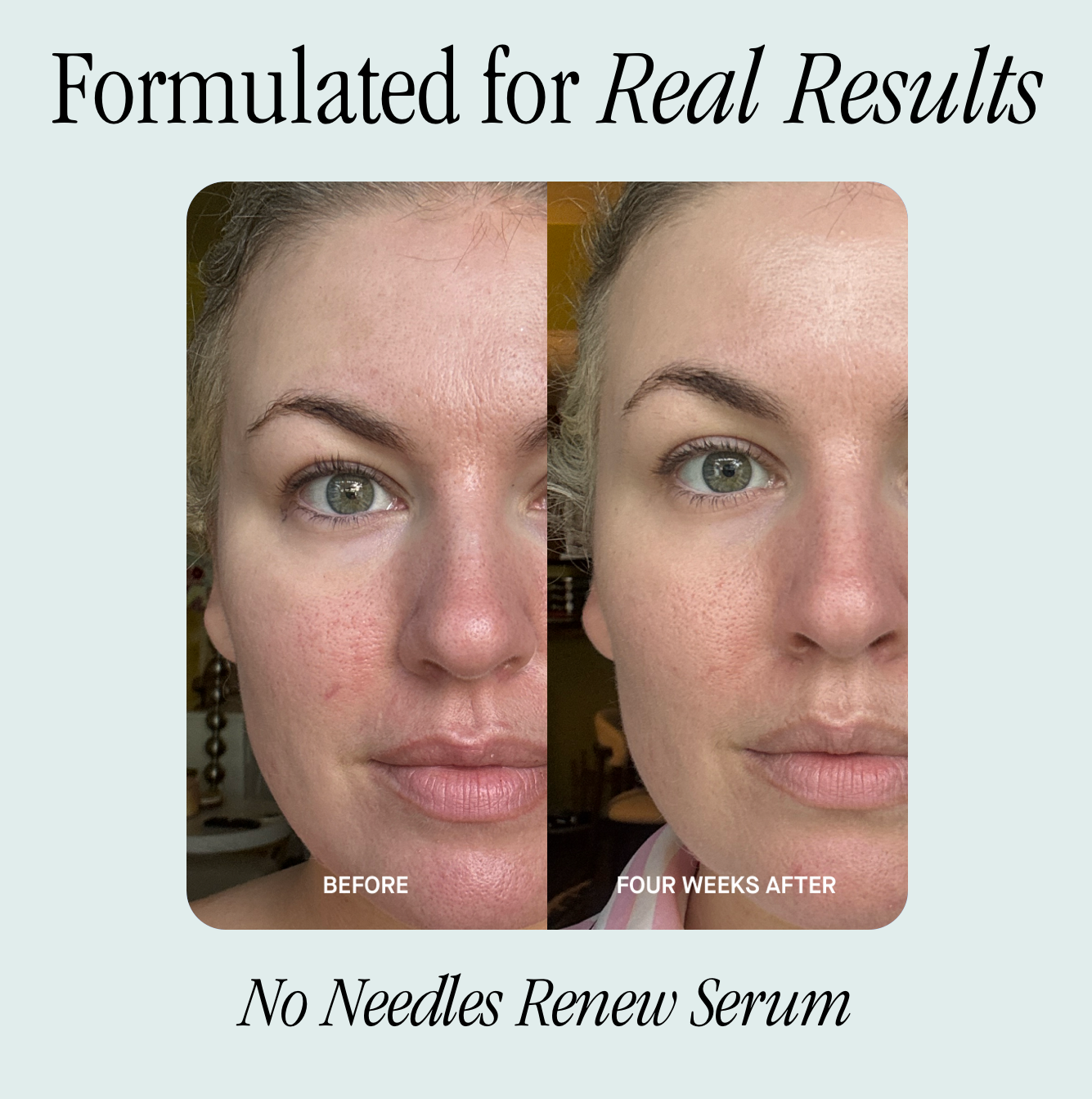 No Needles