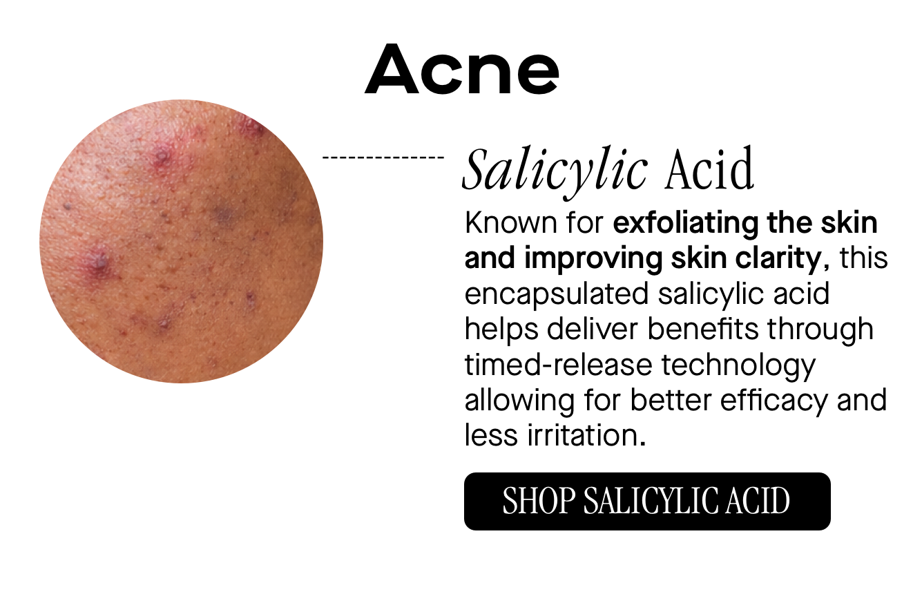 Acne