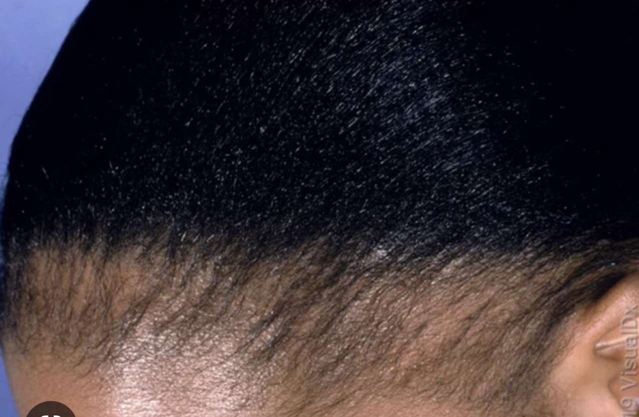 ARE YOUR EDGES BALDING? WE CAN HELP 🥰 East African Secrets