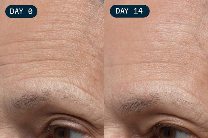 Side-by-side close-up of a forehead and eye area labeled Day 0 and Day 14, showing a reduction in fine lines and smoother-looking skin after two weeks.