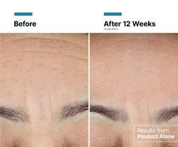 Side-by-side comparison of a person’s forehead labeled “Before” and “After 12 Weeks,” showing visible reduction in fine lines and wrinkles after treatment, with a note indicating results from the product alone.
