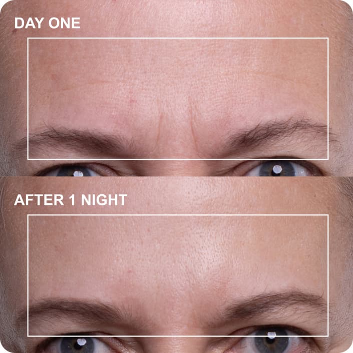 Forehead Before and After